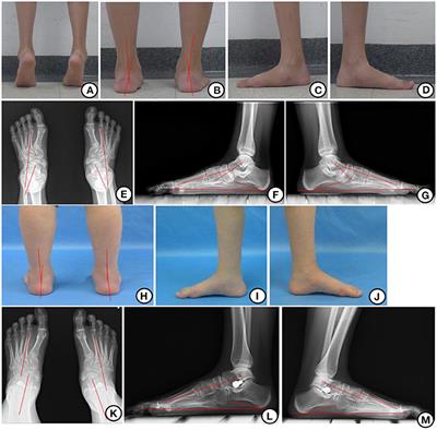 Frontiers | HyProCure for Pediatric Flexible Flatfoot: What